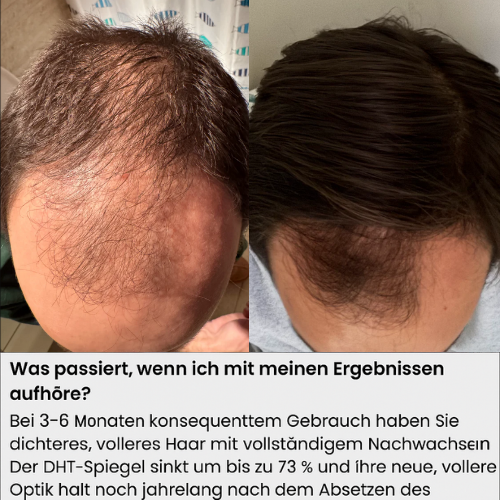 SenviaInfuse™ Haarauswachssystem