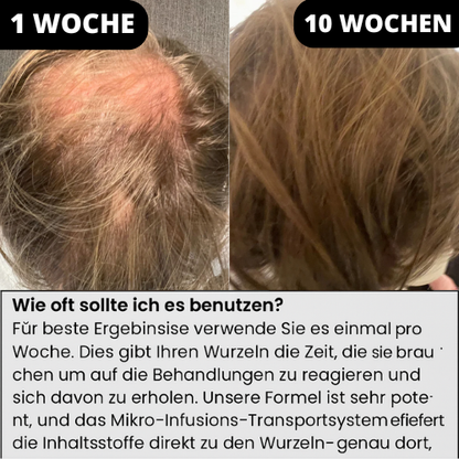 SenviaInfuse™ Haarauswachssystem